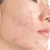 skincare untuk menghilangkan bekas jerawat