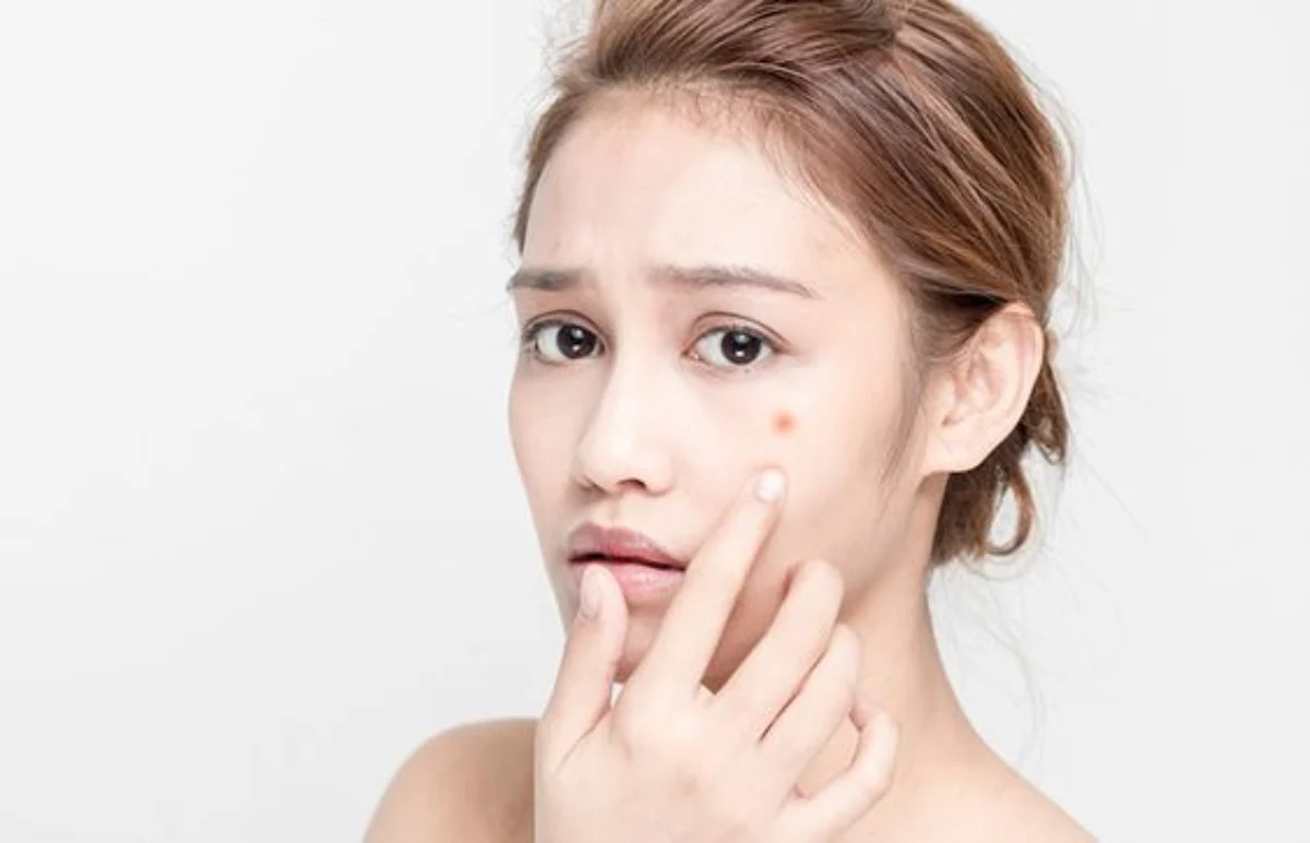 Ini Penyebab dan Cara Mengatasi Jerawat di Pipi – Rakcer.ID