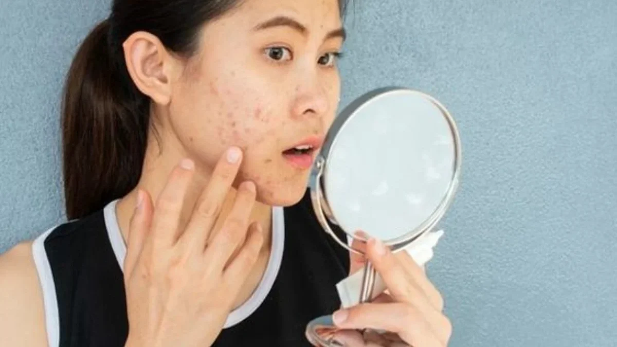 7 Rekomendasi Moisturizer yang Cocok untuk Kulit Berjerawat