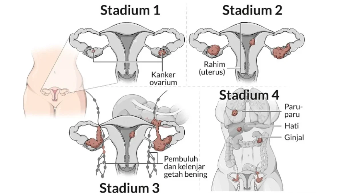 Kunci Mengatasi Kanker Ovarium