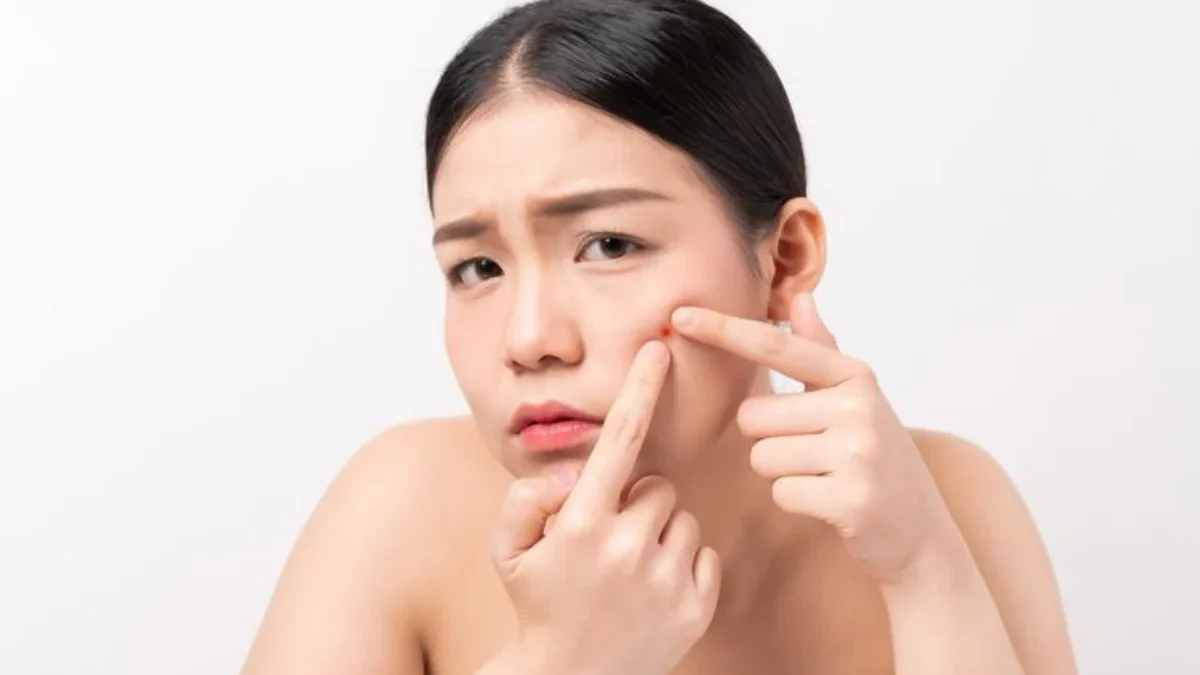 Tips Mencegah Purging pada Wajah Setelah Menggunakan Skincare Baru