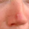 Jerawat Nangkring di Hidung? Hati-hati, Ini 4 Biang Keroknya!