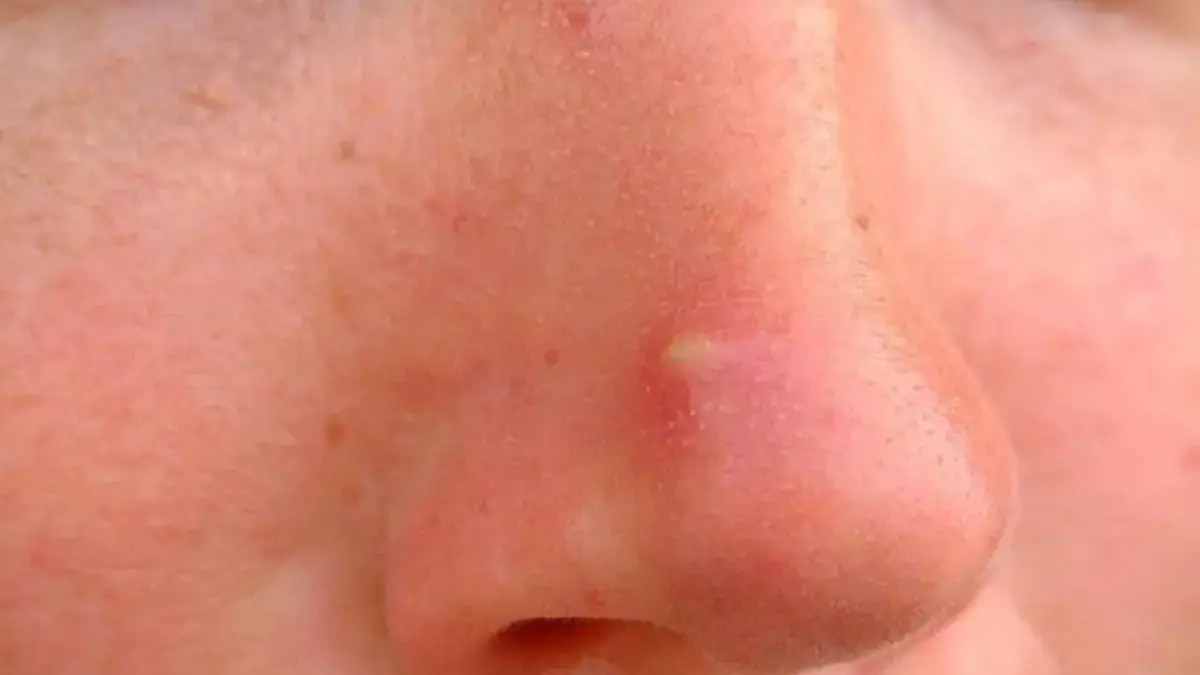 Jerawat Nangkring di Hidung? Hati-hati, Ini 4 Biang Keroknya!