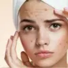 Tips Mengatasi Jerawat dan Bekasnya dengan Produk Alami