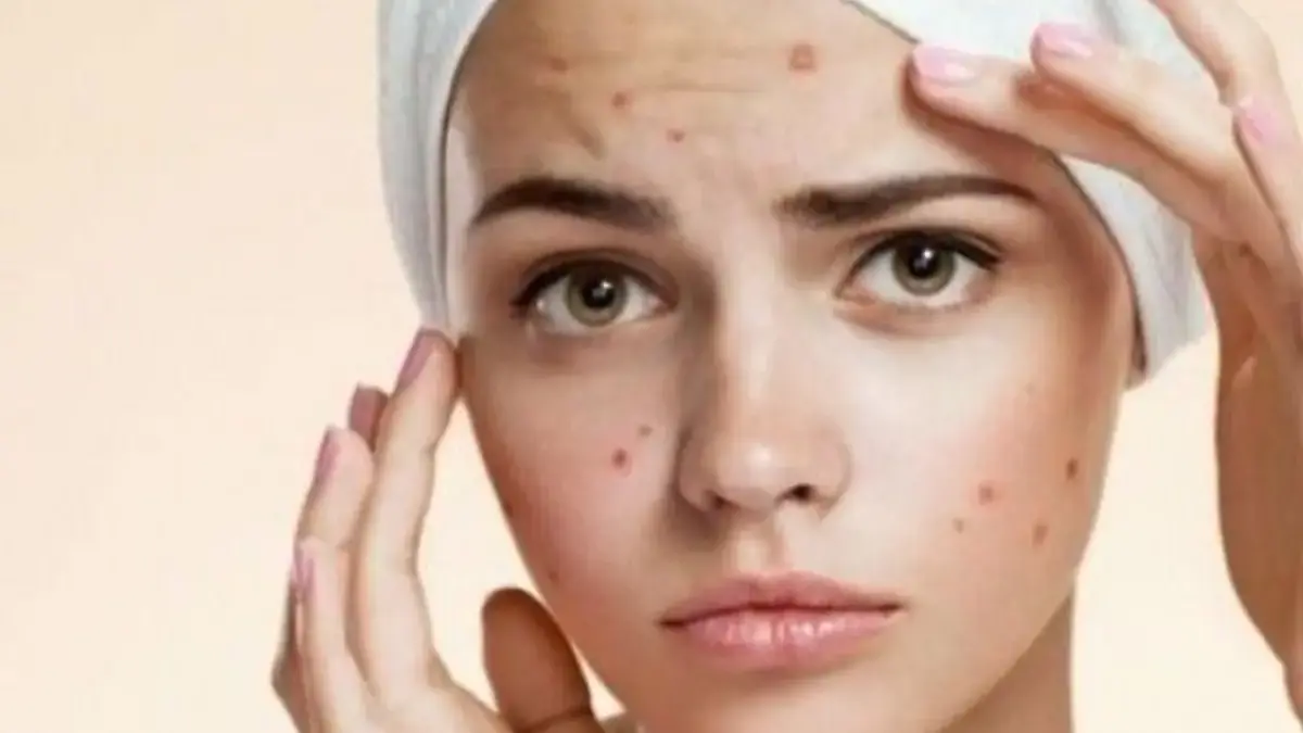 Tips Mengatasi Jerawat dan Bekasnya dengan Produk Alami