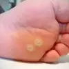 Cara Mengobati Mata Ikan di Kaki,