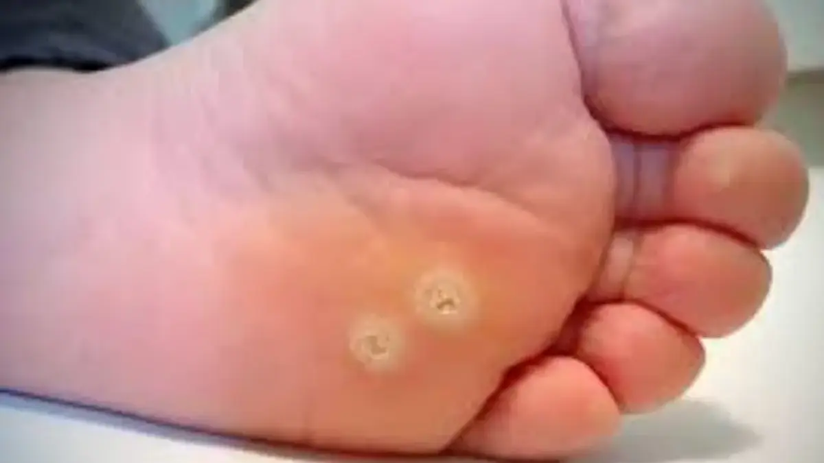 Cara Mengobati Mata Ikan di Kaki,